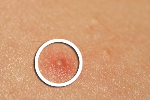 diş macununun farklı kullanımları ve sivilce