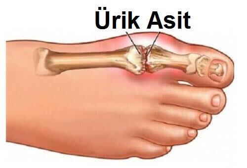 ürik asit ayak parmağı resmi