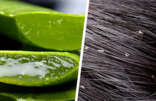 Kepekten Kurtulmak için Etkili ve Kolay İpuçları