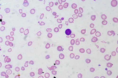 anemi hücreleri