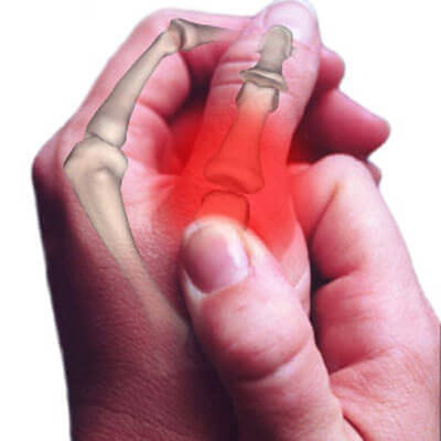 artrit parmak çıtlatma