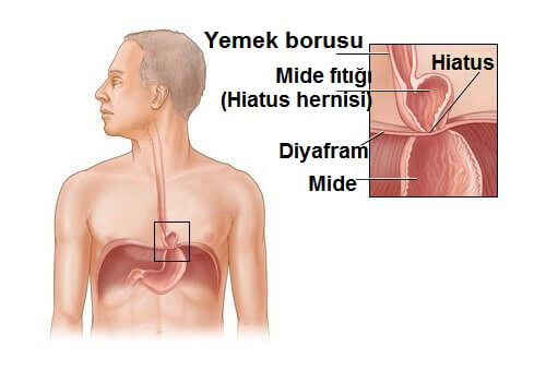Mide Fıtığı İyileştirilebilir Mi?