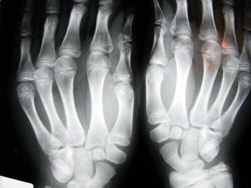 osteoartrit röntgen