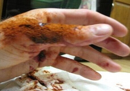 Vetigel: Kanamayı 10 Saniyede Durduran Jel