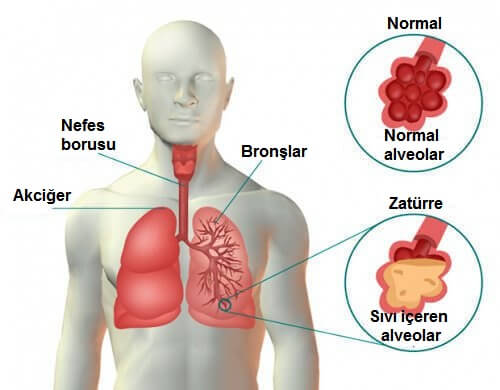Zatürre Belirtileri ve Tedavisi Nelerdir?