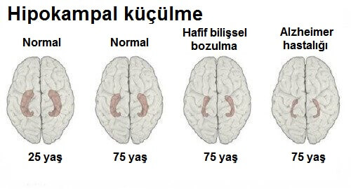 Alzheimer Hastalığının Erken Belirtilerini Tanıyın