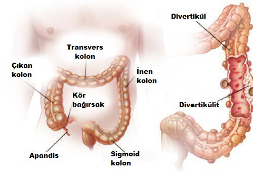 Divertikülit ve Divertiküloz: Tanı ve Tedavi