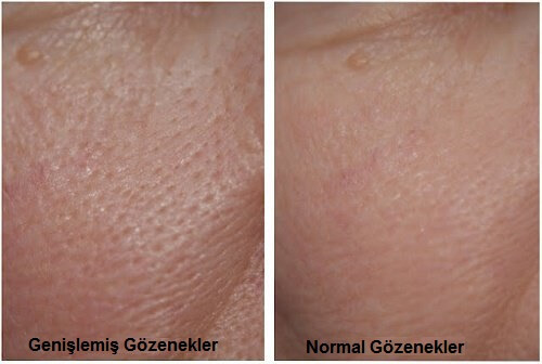 Genişlemiş Gözenekler için 3 Maske