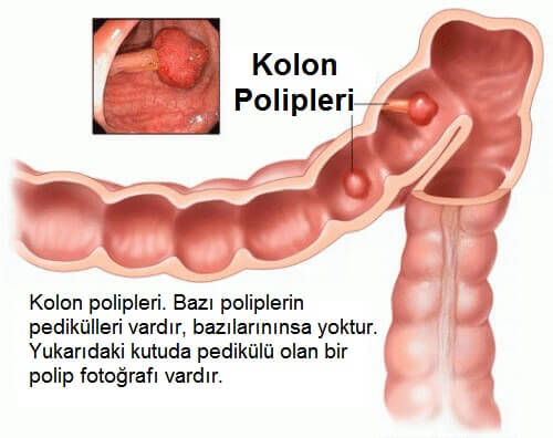 kolon polipleri