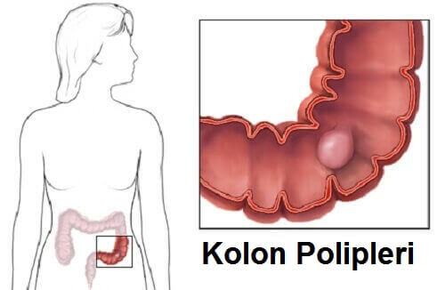 Kolon Polipleri Hakkındaki Gerçekler