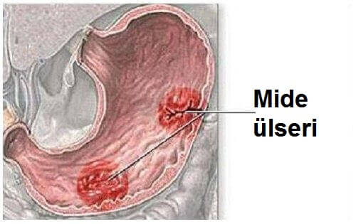Mide Ülserinin Nedenleri ve Belirtileri