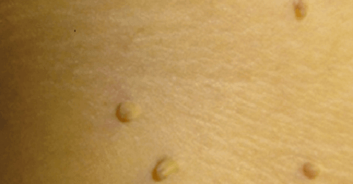 Siğil İçin 10 Doğal Tedavi