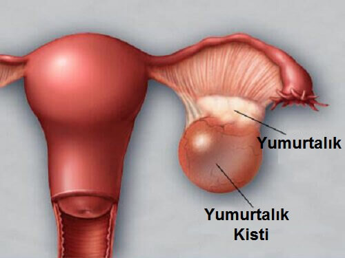Yumurtalık Sağlığını Etkileyen 5 Faktör