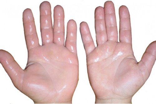 Şişmiş Eller İçin 6 Ev Yapımı Tedavi