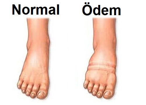 Ödeme Karşı Nasıl Mücadele Verilir?