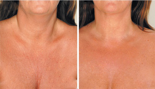 dekolte kırışıklığı