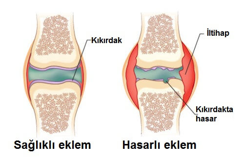sağlıklı ve hasarlı eklem farkı