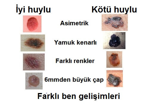 melanom işaretleri
