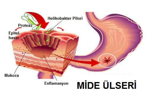 Helikobakter Pilori Bakterisiyle Savaşmak