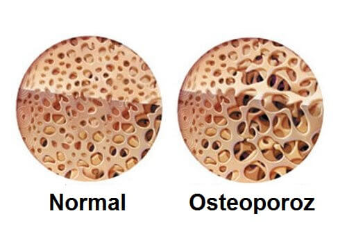 Osteoporoz ile Menopoz Döneminde Mücadele