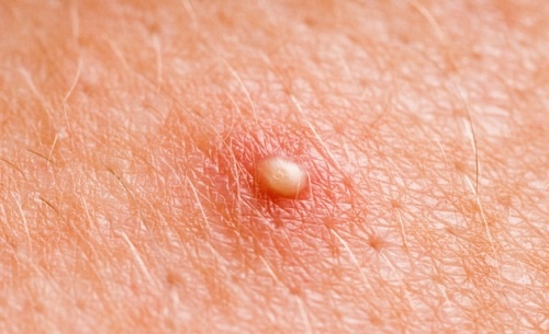 Evde Yapabileceğiniz Çıban Tedavileri