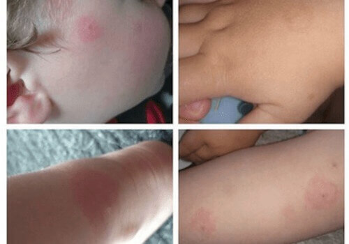 Lyme Hastalığı ve Taşıdığı Riskler