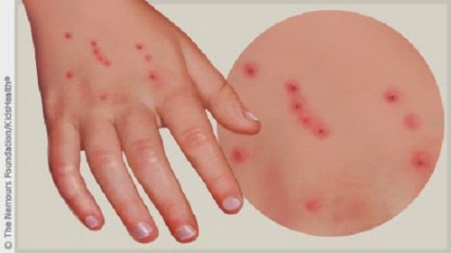 Lyme hastalığı
