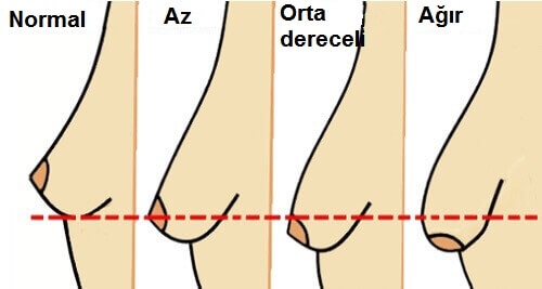 Bu 5 Alışkanlık Göğüs Sarkması Yapabilir!