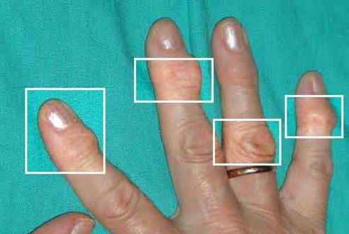 Artrite İyi Gelen Doğal Tedaviler ve Alternatif Yöntemler