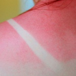 Güneş Yanıkları İçin En İyi Tedaviler