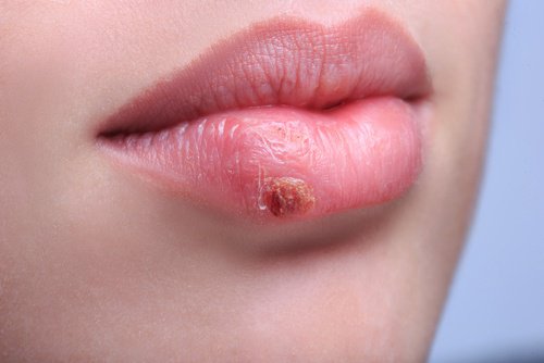 Herpes Herpesinden Nasıl Kurtulur Herpes Herpesinden Nasıl Kurtulur