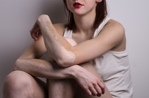 vitiligo kol