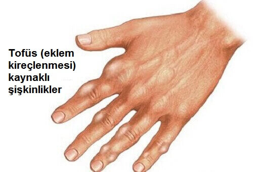 Ürik Asit Seviyesini Doğal Yöntemler İle Azaltın