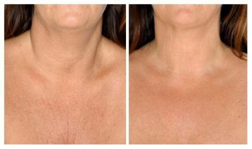 En iyi Doğal Boyun Cilt Bakımı