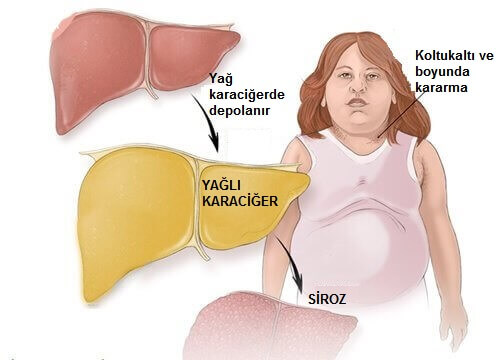 karaciğer yağlanması nasıl olur