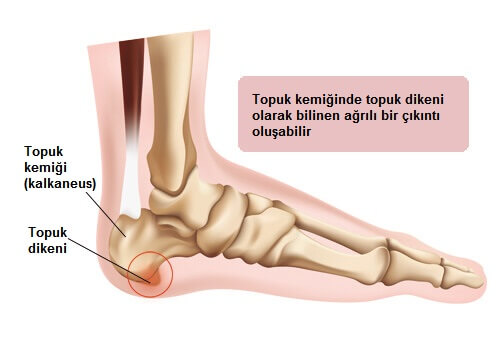 topuk-ağrısı-çizelgesi