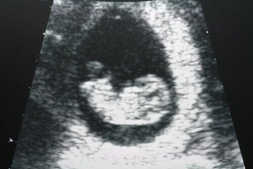 ultrason-görüntüsü-bebek