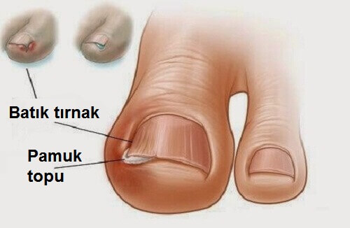 batık-tırnak