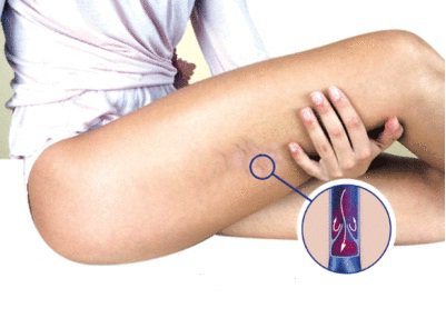 kolda damar sertliği