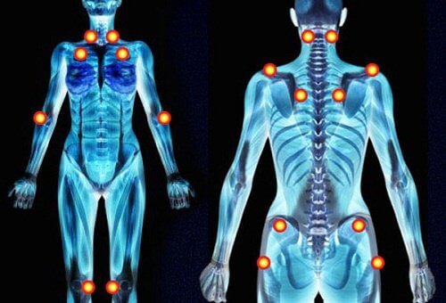1-fibromyalgia