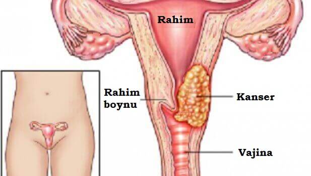 Rahim Kanserine Yol Açabilecek 7 Faktör
