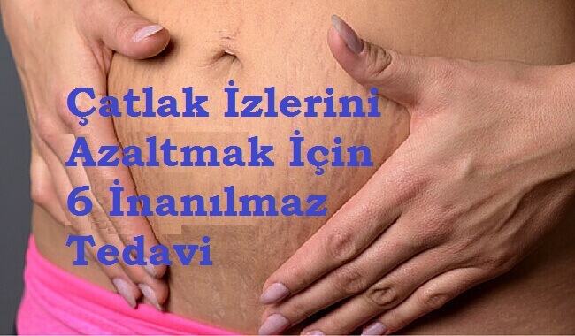 Çatlak İzlerini Azaltmak İçin İnanılmaz 6 Tedavi