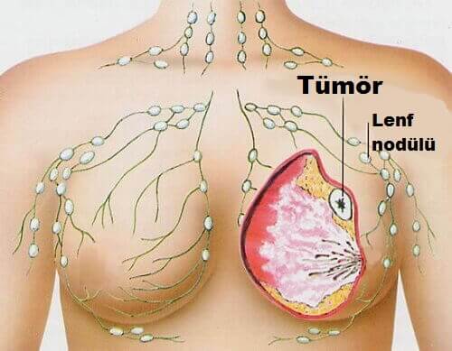 Çalışmalara Göre Göğüs Kanseri Bu Yiyecek ile Önlenebilir