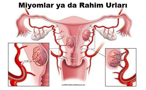 Rahim Tümörleri: Bilmeniz Gereken 5 Şey