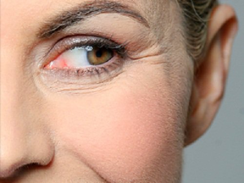 göz altı kırışıklıkları