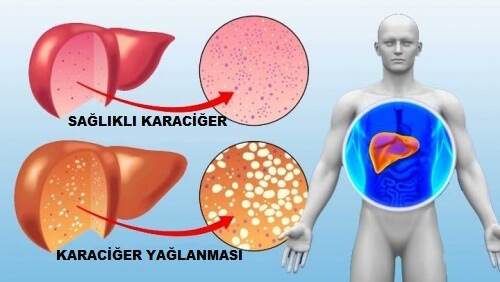 Karaciğer Temizleyici 10 Detoks Gıda