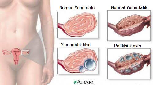 Yumurtalık Kistleri Hakkında 9 Gerçek