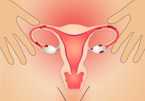 4-endometriosis