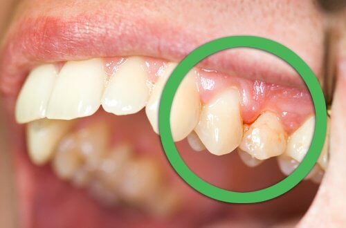Diş Ağrısına Yol Açabilecek 6 Neden Sağlığa bir adım