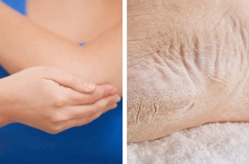 Kuru Dirsek ve Topukları Doğal Yöntemlerle Yumuşatın